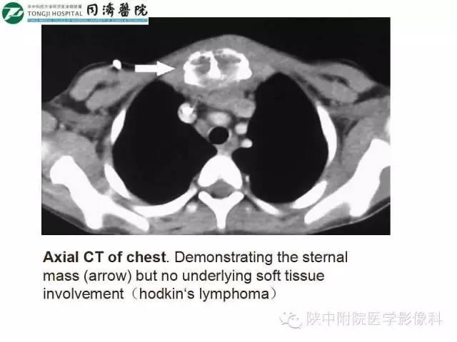 【PPT】血液系统疾病在骨关节的改变——影像学表现