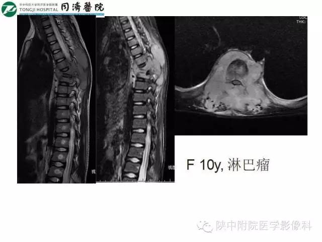 【PPT】血液系统疾病在骨关节的改变——影像学表现