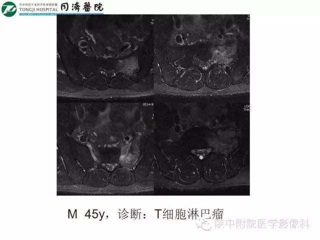 【PPT】血液系统疾病在骨关节的改变——影像学表现