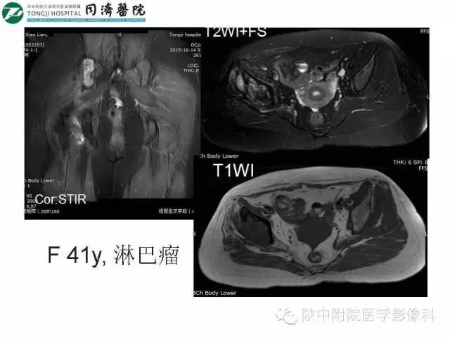 【PPT】血液系统疾病在骨关节的改变——影像学表现