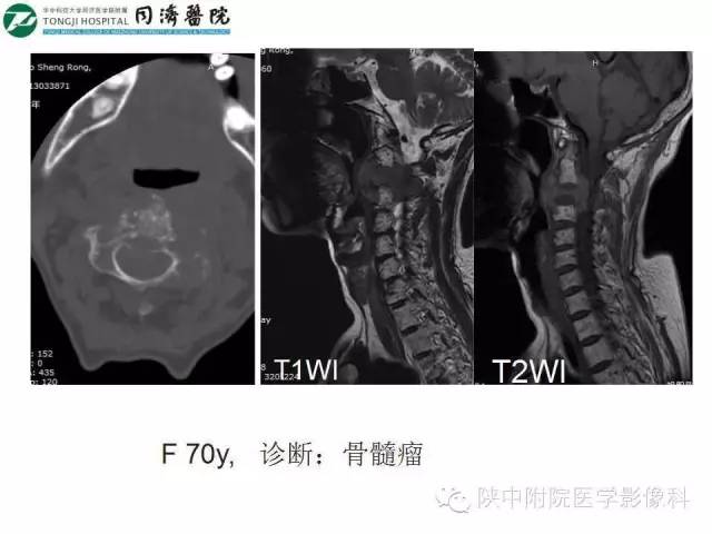 【PPT】血液系统疾病在骨关节的改变——影像学表现