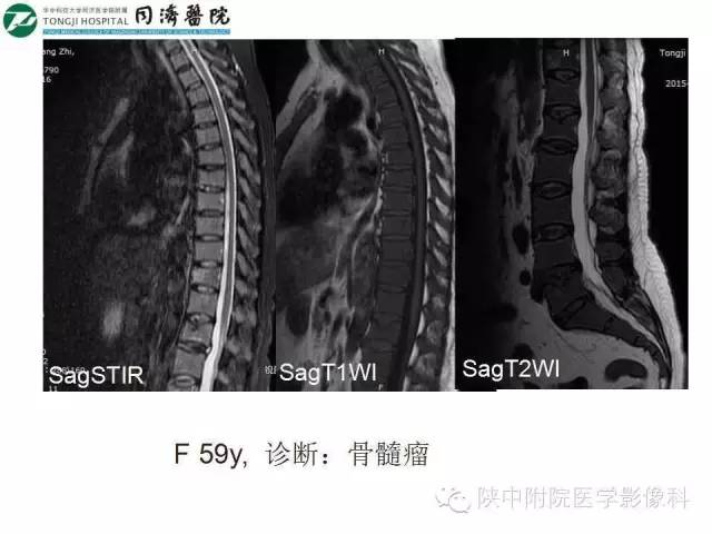 【PPT】血液系统疾病在骨关节的改变——影像学表现