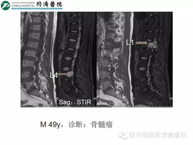 【PPT】血液系统疾病在骨关节的改变——影像学表现