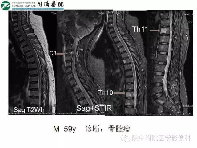【PPT】血液系统疾病在骨关节的改变——影像学表现