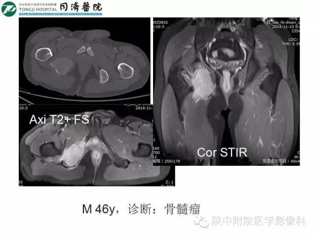 【PPT】血液系统疾病在骨关节的改变——影像学表现