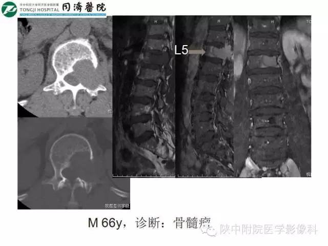 【PPT】血液系统疾病在骨关节的改变——影像学表现