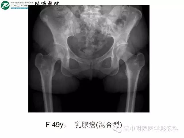 【PPT】血液系统疾病在骨关节的改变——影像学表现
