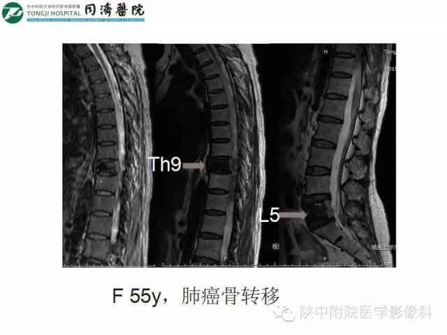 【PPT】血液系统疾病在骨关节的改变——影像学表现