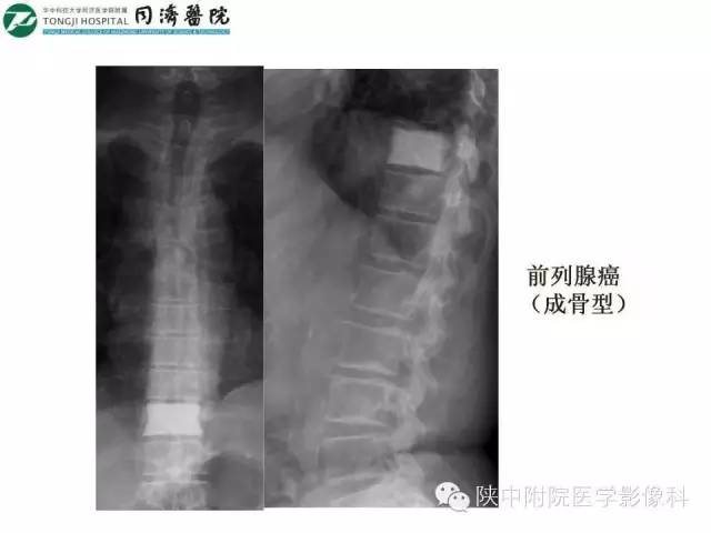 【PPT】血液系统疾病在骨关节的改变——影像学表现