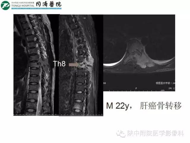 【PPT】血液系统疾病在骨关节的改变——影像学表现