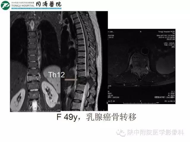 【PPT】血液系统疾病在骨关节的改变——影像学表现