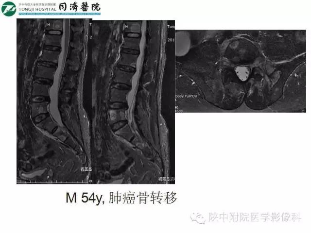 【PPT】血液系统疾病在骨关节的改变——影像学表现