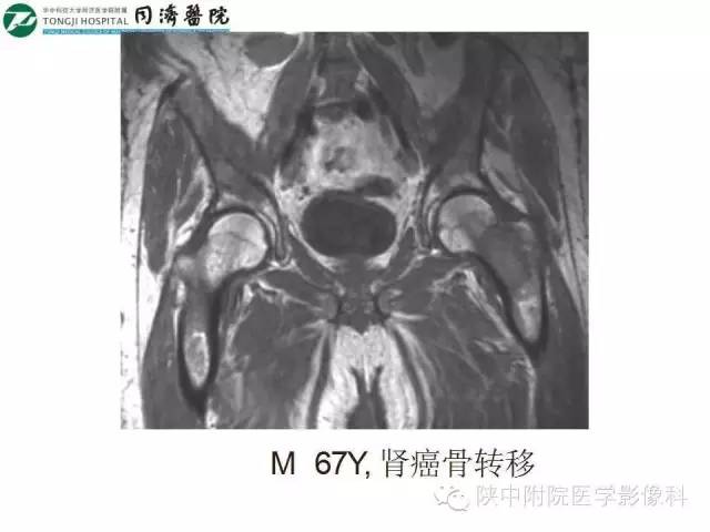 【PPT】血液系统疾病在骨关节的改变——影像学表现