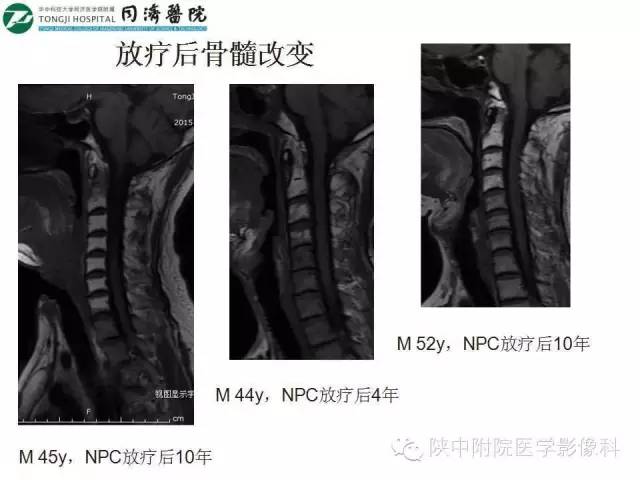 【PPT】血液系统疾病在骨关节的改变——影像学表现
