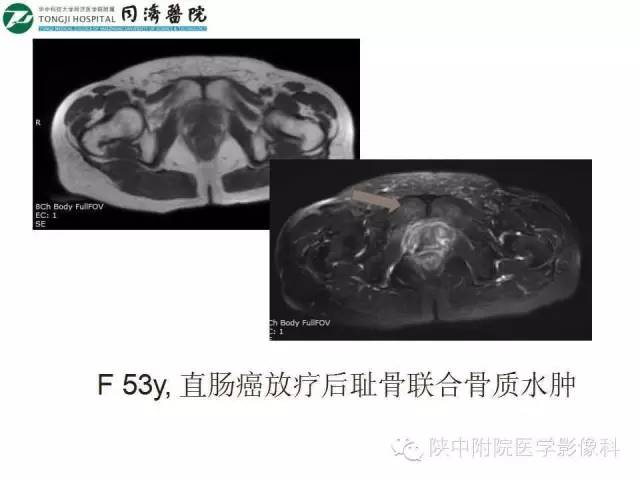 【PPT】血液系统疾病在骨关节的改变——影像学表现