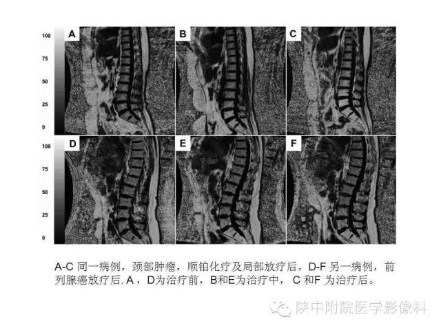 【PPT】血液系统疾病在骨关节的改变——影像学表现