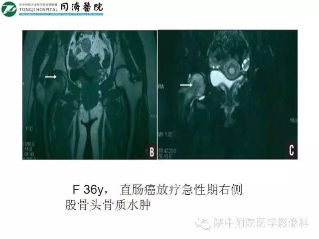 【PPT】血液系统疾病在骨关节的改变——影像学表现
