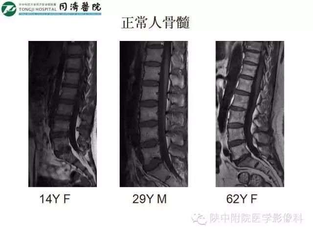 【PPT】血液系统疾病在骨关节的改变——影像学表现