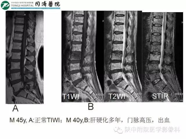 【PPT】血液系统疾病在骨关节的改变——影像学表现