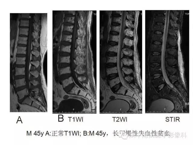 【PPT】血液系统疾病在骨关节的改变——影像学表现