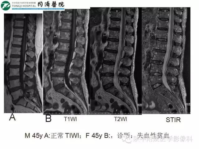 【PPT】血液系统疾病在骨关节的改变——影像学表现