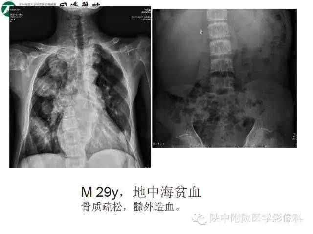 【PPT】血液系统疾病在骨关节的改变——影像学表现