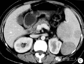 【病例】脾窦岸细胞血管瘤1例CT影像表现 【病例】脾窦岸细胞血管瘤1例CT影像表现