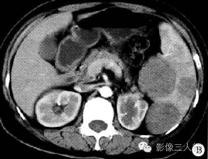 【病例】脾窦岸细胞血管瘤1例CT影像表现 【病例】脾窦岸细胞血管瘤1例CT影像表现