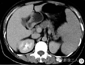 【病例】脾窦岸细胞血管瘤1例CT影像表现 【病例】脾窦岸细胞血管瘤1例CT影像表现
