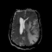 【病例】左颞叶淋巴瘤1例MR影像表现 【病例】左颞叶淋巴瘤1例MR影像表现