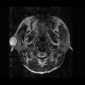 【病例】右颞部表皮样囊肿1例MR影像表现 【病例】右颞部表皮样囊肿1例MR影像表现