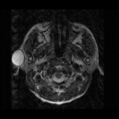【病例】右颞部表皮样囊肿1例MR影像表现 【病例】右颞部表皮样囊肿1例MR影像表现