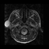 【病例】右颞部表皮样囊肿1例MR影像表现 【病例】右颞部表皮样囊肿1例MR影像表现