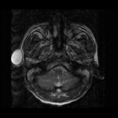 【病例】右颞部表皮样囊肿1例MR影像表现 【病例】右颞部表皮样囊肿1例MR影像表现