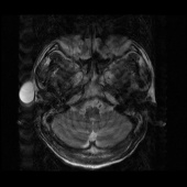 【病例】右颞部表皮样囊肿1例MR影像表现 【病例】右颞部表皮样囊肿1例MR影像表现