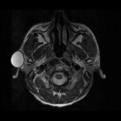 【病例】右颞部表皮样囊肿1例MR影像表现 【病例】右颞部表皮样囊肿1例MR影像表现