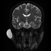 【病例】右颞部表皮样囊肿1例MR影像表现 【病例】右颞部表皮样囊肿1例MR影像表现