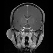【病例】右颞部表皮样囊肿1例MR影像表现 【病例】右颞部表皮样囊肿1例MR影像表现