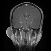 【病例】右颞部表皮样囊肿1例MR影像表现 【病例】右颞部表皮样囊肿1例MR影像表现
