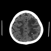 【病例】系统性红斑狼疮脑病1例CT影像表现 【病例】系统性红斑狼疮脑病1例CT影像表现