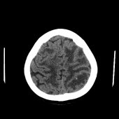 【病例】系统性红斑狼疮脑病1例CT影像表现 【病例】系统性红斑狼疮脑病1例CT影像表现