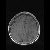 【病例】系统性红斑狼疮脑病1例CT影像表现 【病例】系统性红斑狼疮脑病1例CT影像表现