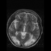 【病例】系统性红斑狼疮脑病1例CT影像表现 【病例】系统性红斑狼疮脑病1例CT影像表现