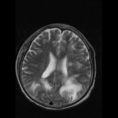 【病例】系统性红斑狼疮脑病1例CT影像表现 【病例】系统性红斑狼疮脑病1例CT影像表现
