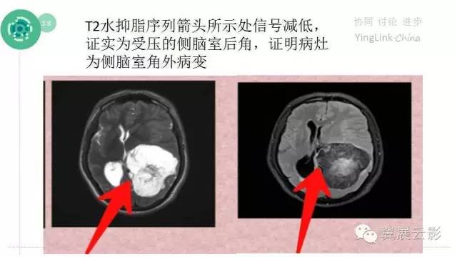 【PPT】脑表皮样囊肿的影像诊断与鉴别
