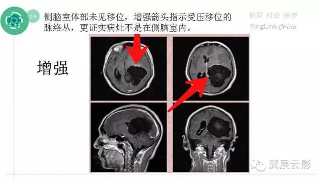【PPT】脑表皮样囊肿的影像诊断与鉴别