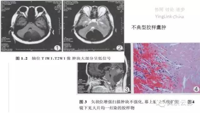 【PPT】脑表皮样囊肿的影像诊断与鉴别