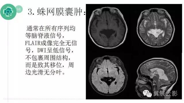 【PPT】脑表皮样囊肿的影像诊断与鉴别
