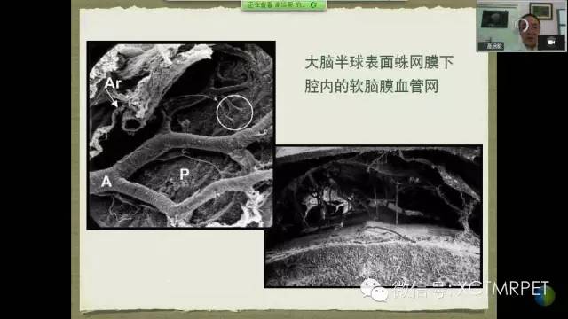 【PPT】脑小血管病影像与临床