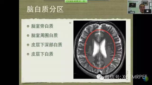 【PPT】脑小血管病影像与临床